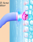 Theia Dual Color Strong Acne Away Magic Light Wand